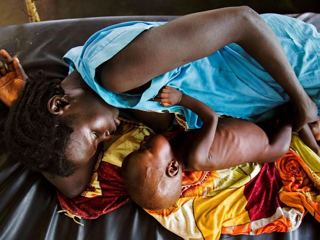 A mother breastfeeds her child, who is suffering from acute malnutrition, at a Doctors without Borders clinic in South Sudan Getty Images