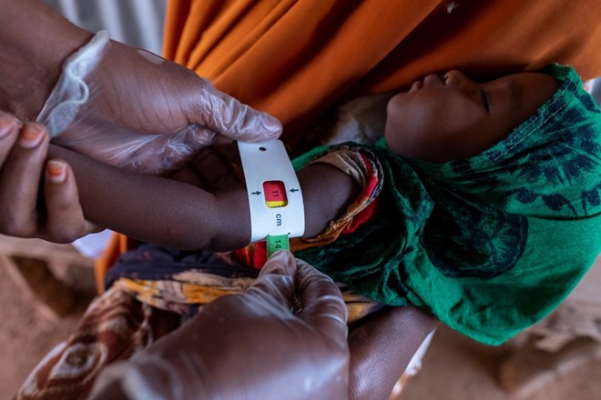 Seven-month-old Fardowsa Adan Mohamed is examined in a UNICEF-funded clinic to find out the extent of malnutrition, due to the severe drought in the region. [Rich/UNICEF]